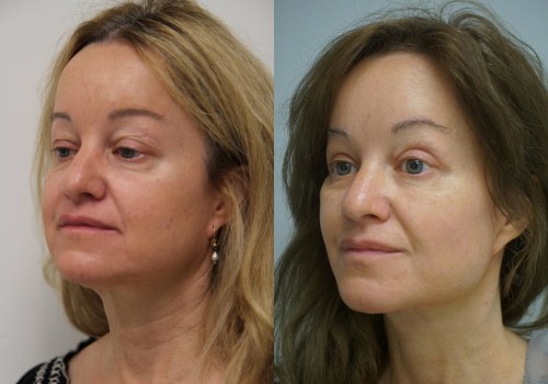 The Ultimate Guide to Affordable Facelift Options: An Expert's Perspective