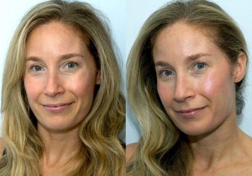 What happens when you stop getting facial fillers?