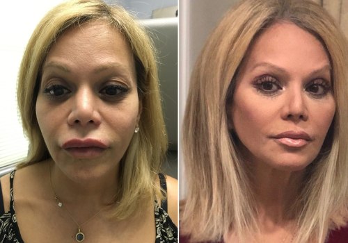 Why did i stop using fillers after 2 years?