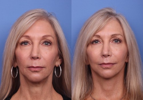 Can cosmetic surgery make you look younger?