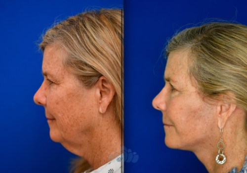 The True Cost of a Facelift: What You Need to Know