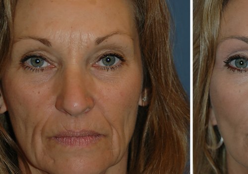 Is it normal for your face to be numb after a facelift?