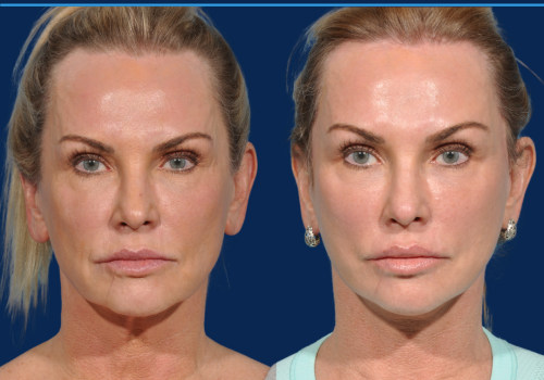 How do you know if you need a mini facelift?