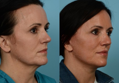 What age is good for mini facelift?