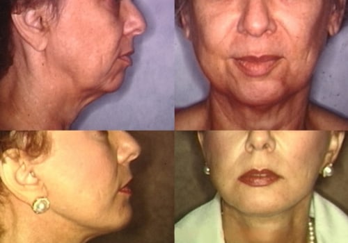 The Longevity of Facelift Results: How to Maximize and Preserve Your Youthful Appearance