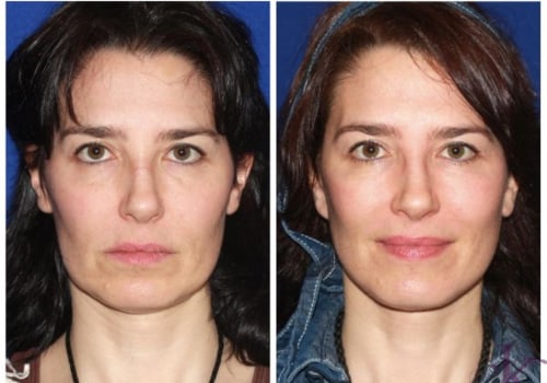 The Benefits of Mini Facelifts for Younger Patients