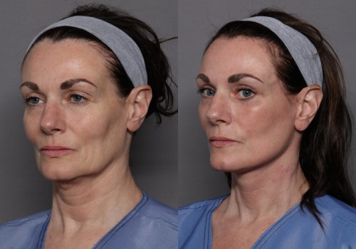 Is a facelift noticeable?