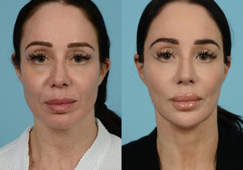 The Ideal Age for a Facelift: Expert Insights