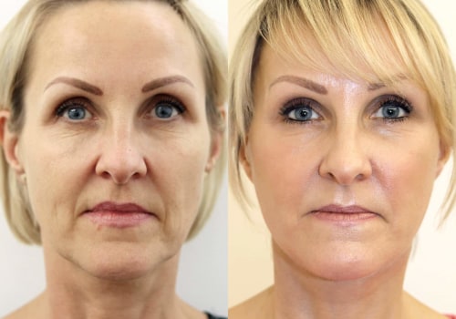 Which face lift lasts the longest?