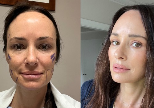 Is it safe to have a second facelift?