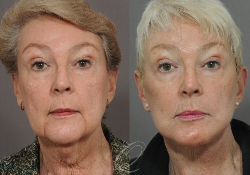 Is 72 too old for a brow lift?