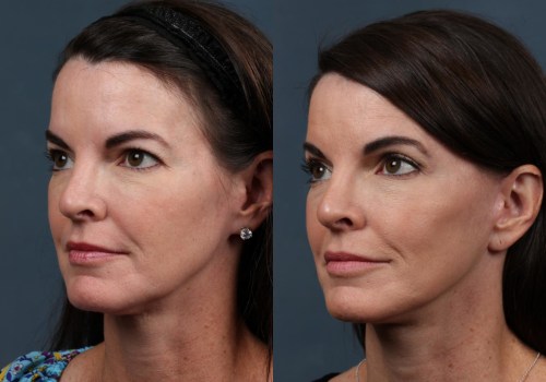 The Truth About Facelifts: Debunking Myths and Exploring the Transformative Effects