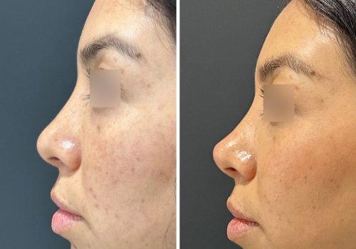 Do fillers disappear over time?