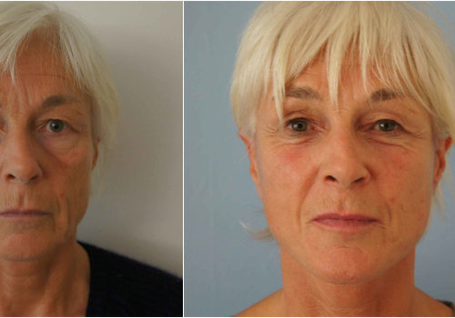 The Ultimate Guide to Facelift Costs in the UK