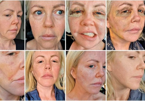 What Happens 10 Years After a Facelift?