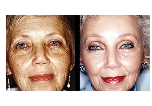 Can cosmetic surgery make you look younger?