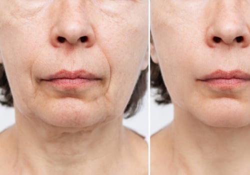 The Longevity of a Facelift: How Long Can You Expect Your Results to Last?