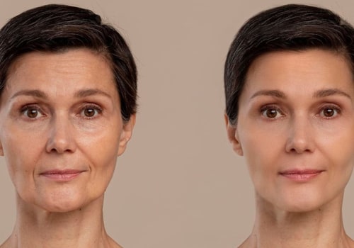 The Cost of a Full Facelift in Florida: What You Need to Know