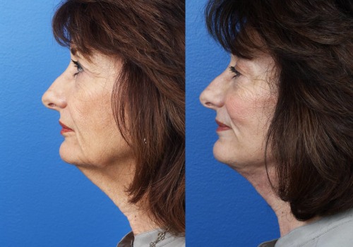 Do i really need a facelift?