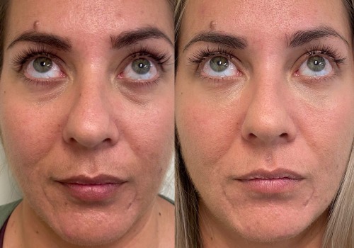 What is the newest non surgical facelift procedure?