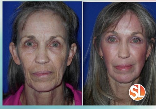 The Power of Facelifts: How Plastic Surgery Can Make You Look 20 Years Younger