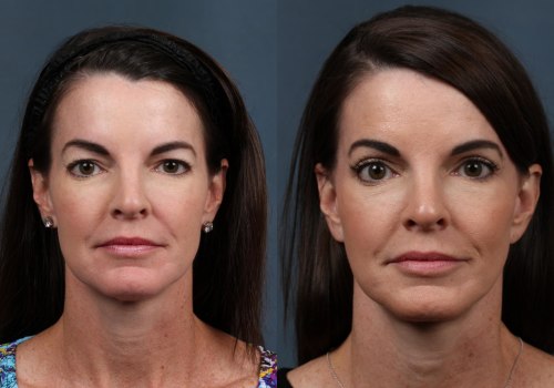 The Optimal Time for a Facelift: Insights from a Plastic Surgeon