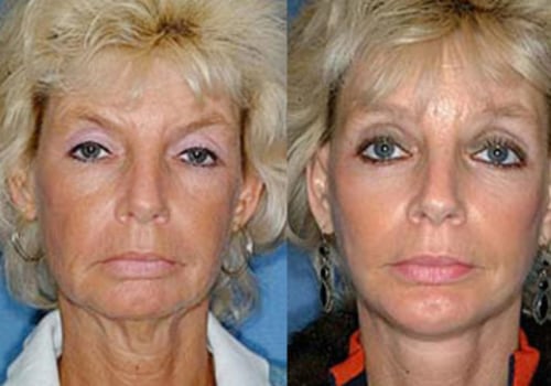 Is 72 too old for a brow lift?