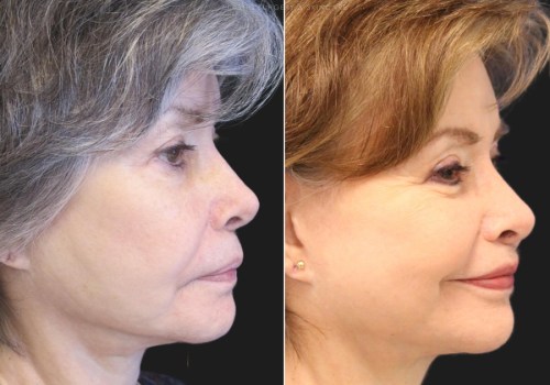 Is 70 too old for face-lift?