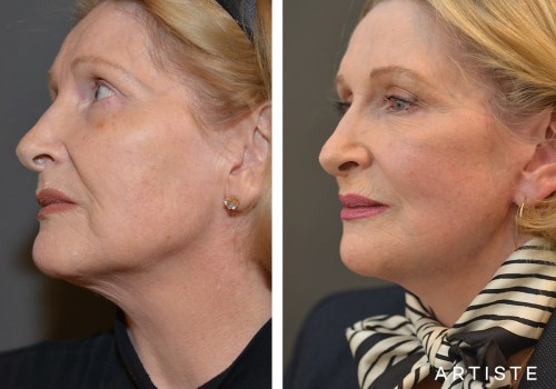 The Truth About Facelifts: Debunking the Myths and Revealing the Facts