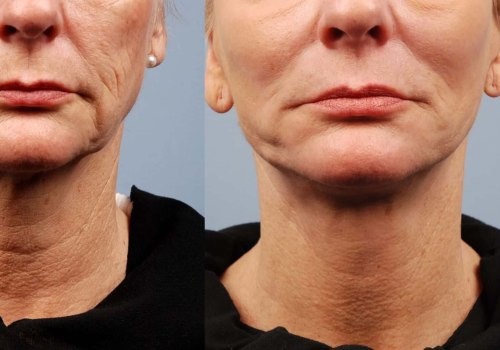 What is the most advanced non-invasive face lift?