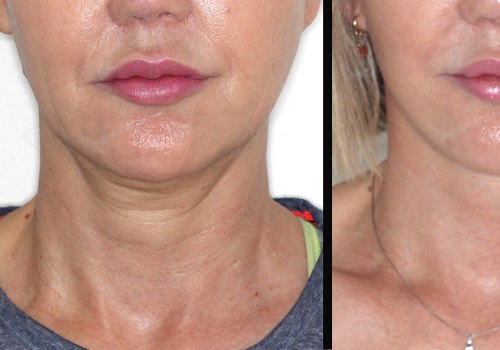 What age is deep plane facelift for?